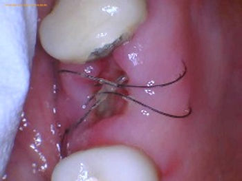 When Do Wisdom Teeth Stitches Dissolve?