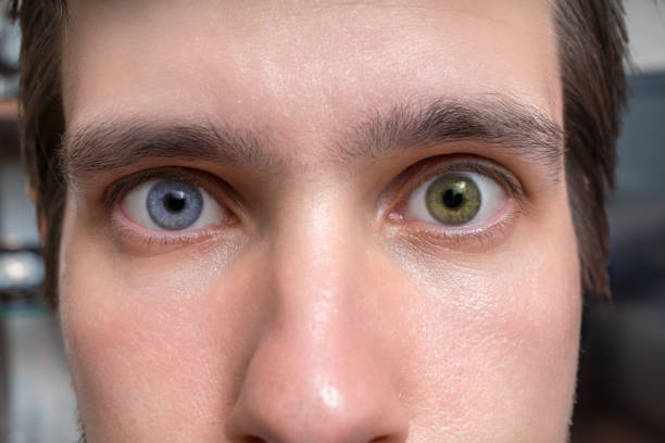 Have Two Different Colored Eyes? Why Today Is Your Day | Wsav-Tv