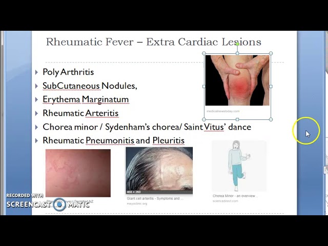 Pathology 436 F Rheumatic Fever Heart Disease Extra Cardiac Lesion Saint  Vitus Dance - Youtube