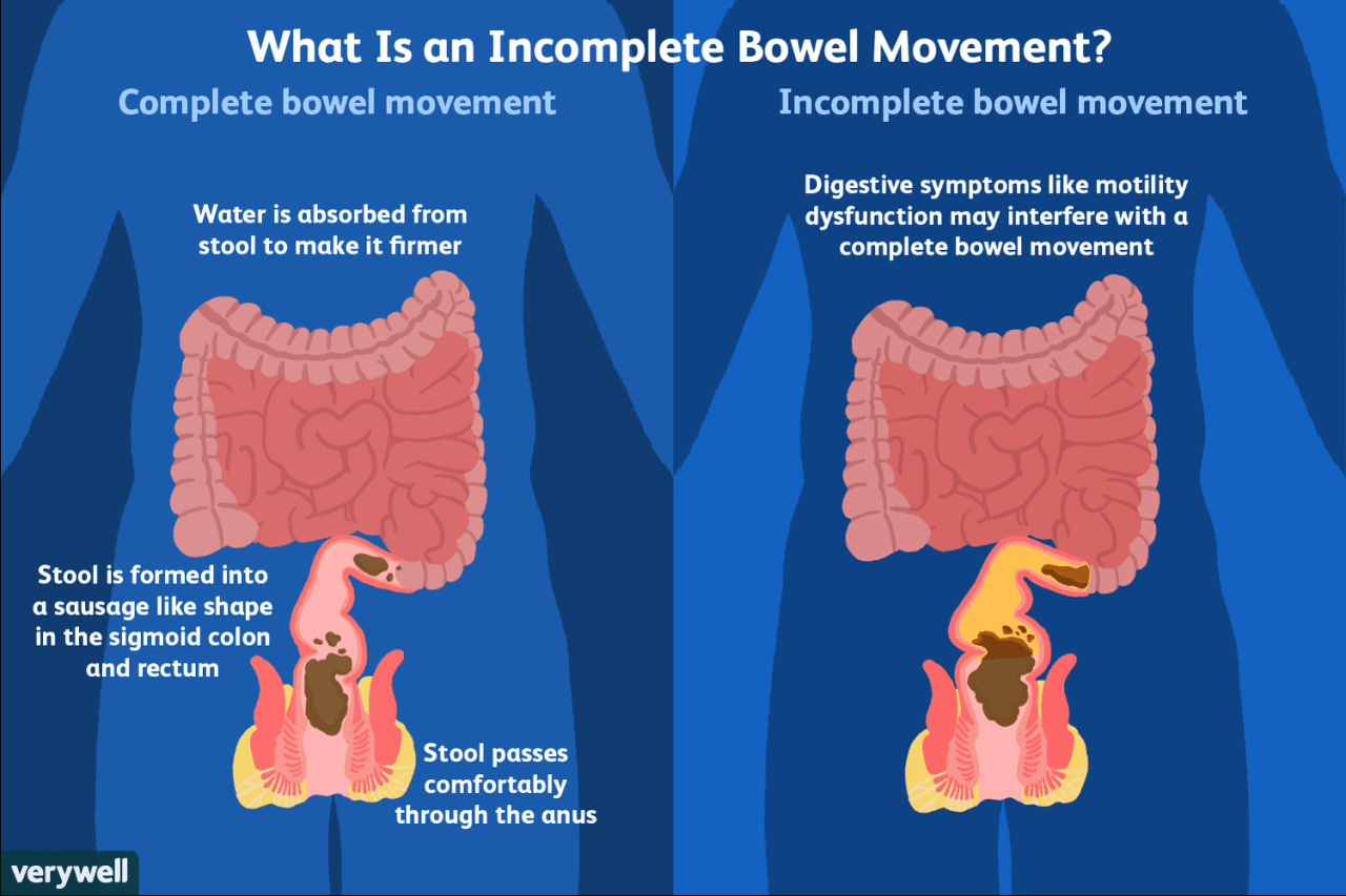 How To Reduce Symptoms Of Incomplete Defecation