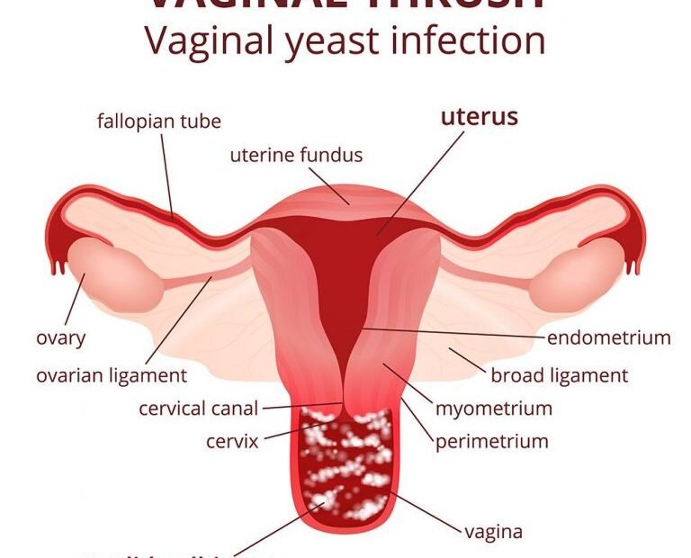 How To Cure A Yeast Infection Naturally — Walnut Creek Naturopathic